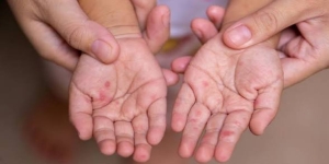 Surto de mão, pé e boca atinge 24 crianças e leva creche de Três Lagoas a ser interditada