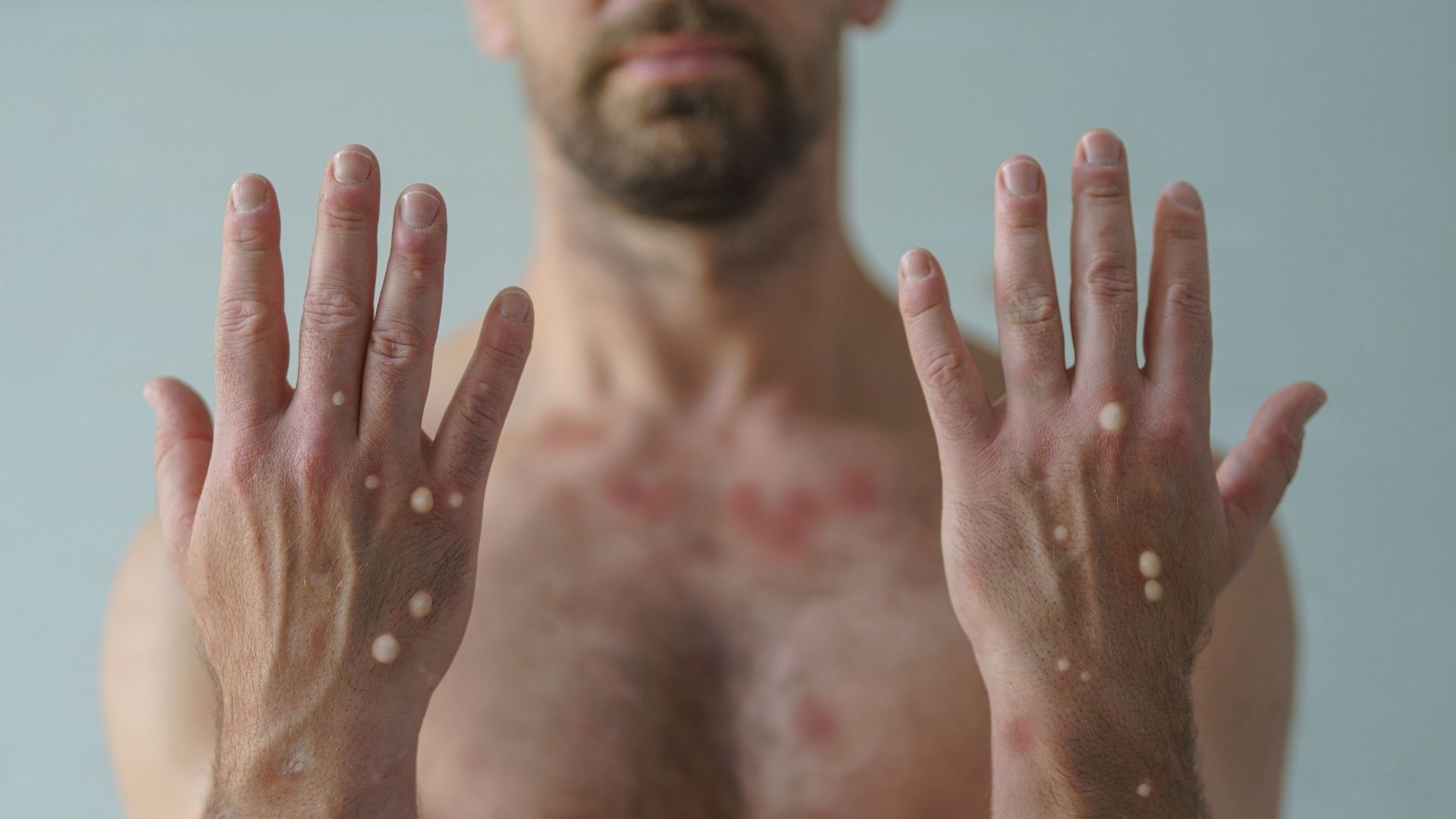 Três Lagoas registra os dois primeiros casos suspeitos de Varíola Monkeypox