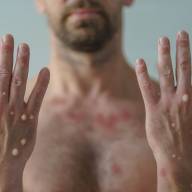 Três Lagoas registra os dois primeiros casos suspeitos de Varíola Monkeypox