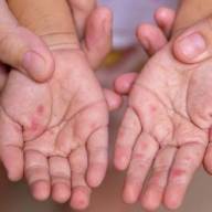 Surto de mão, pé e boca atinge 24 crianças e leva creche de Três Lagoas a ser interditada