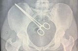 MULHER PASSA MAIS DE 2 MESES COM PINÇA NO CORPO APÓS CIRURGIA EM ARAÇATUBA